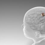 Neuralink : les implants cérébraux d'Elon Musk testés sur les humains dans six mois
